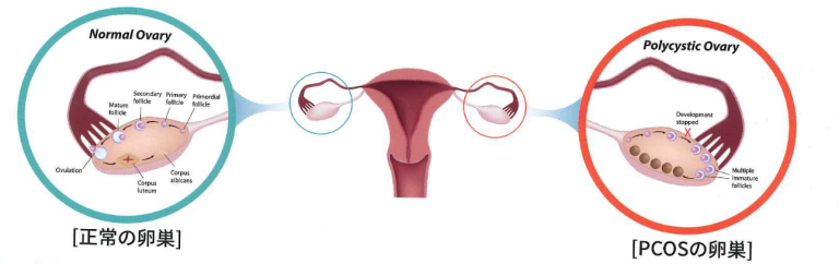 カイロ-イノシトール　卵巣画像